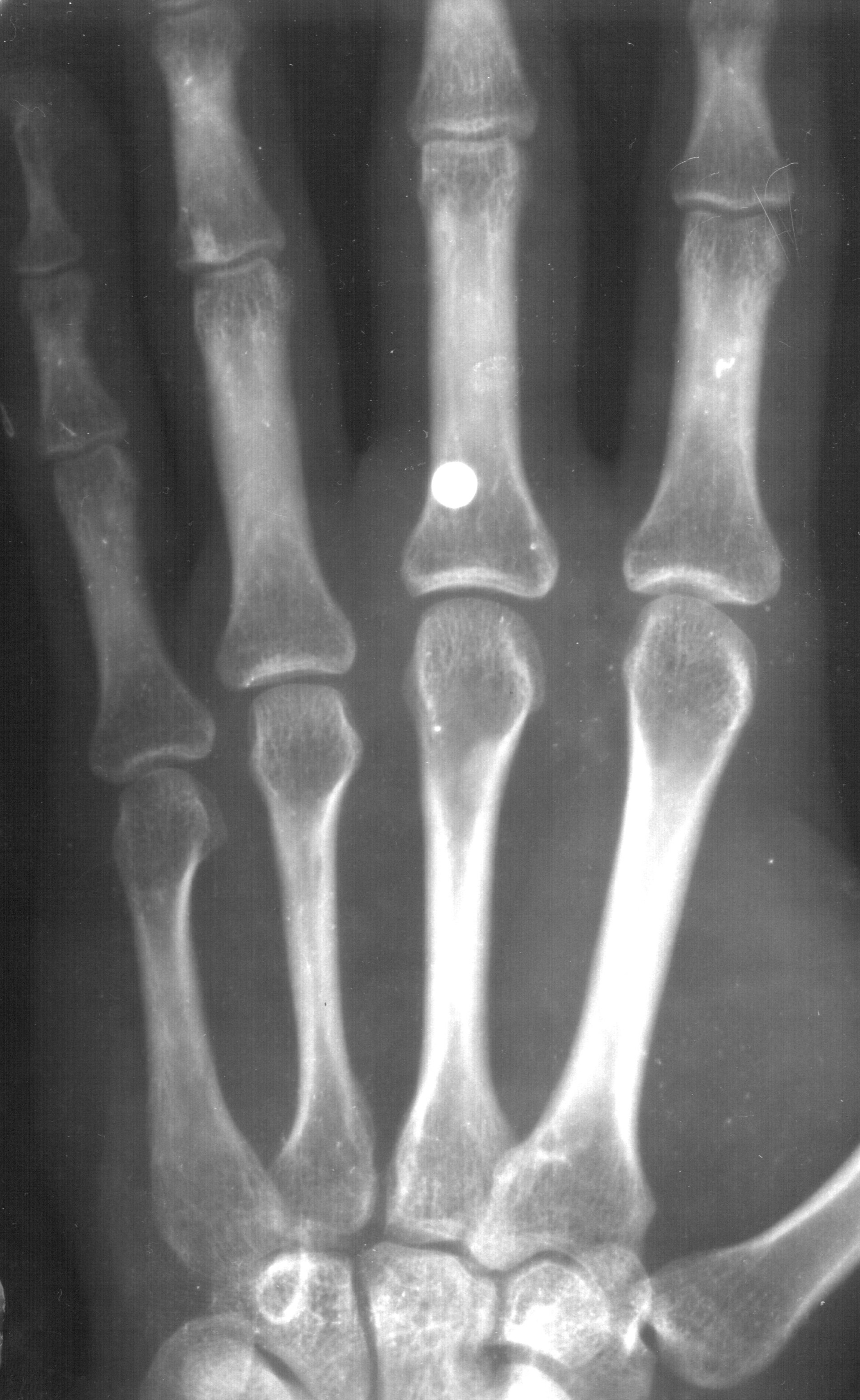Figure 3 — A radiograph of a left hand with a steel BB lodged against the proximal phalanx of the middle finger. The ball is radiopaque and shows as a clean, perfectly round sphere against the bone — the geom…